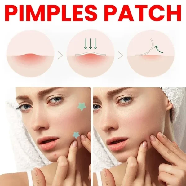 Repair Acne Patch Facial Skin Care Fade Blemishes Pimple Marks Closed Acne Blemishes Cover Acne Pimple Repair Patch - Image 3